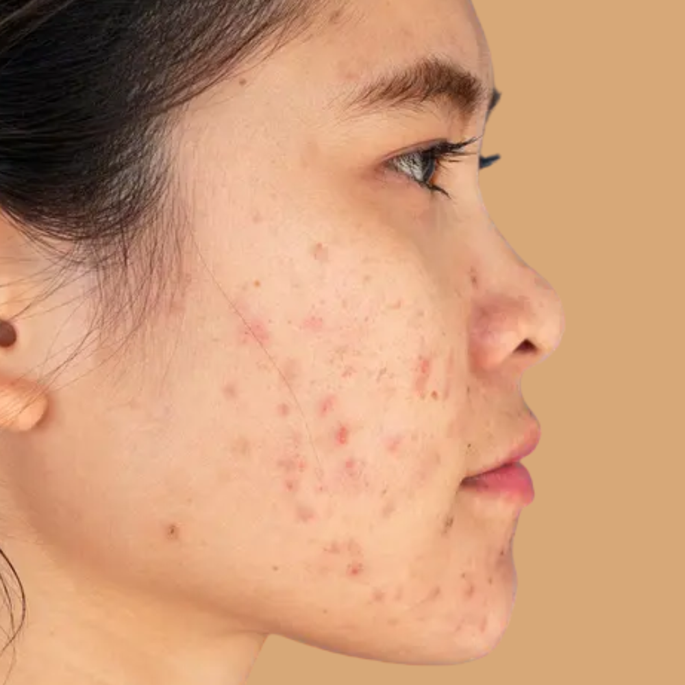 Acne & Breakouts